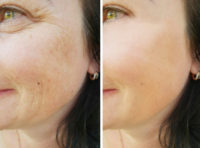 anti wrinkle before after wellington