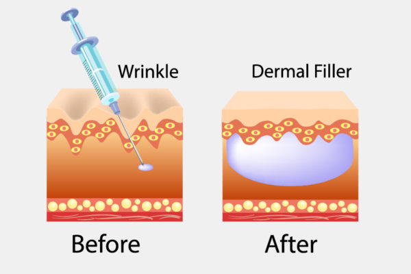 Dermal Fillers Wellington - Cheek And Lip Fillers