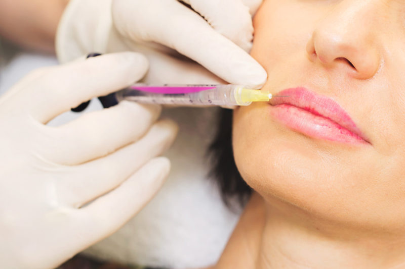 Dermal Fillers Wellington Cheek And Lip Fillers