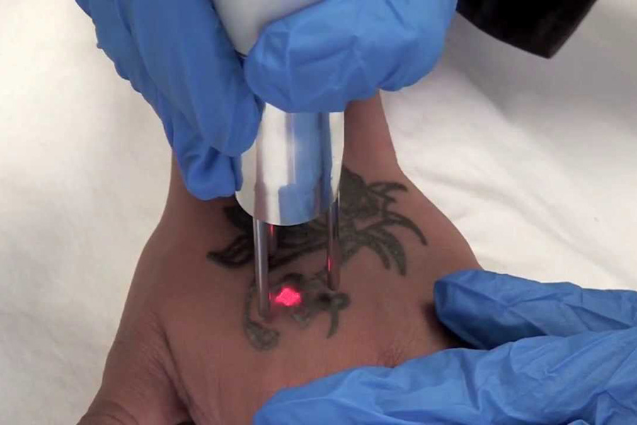 Laser Tattoo Removal Wellington - Safe and Non-Invasive