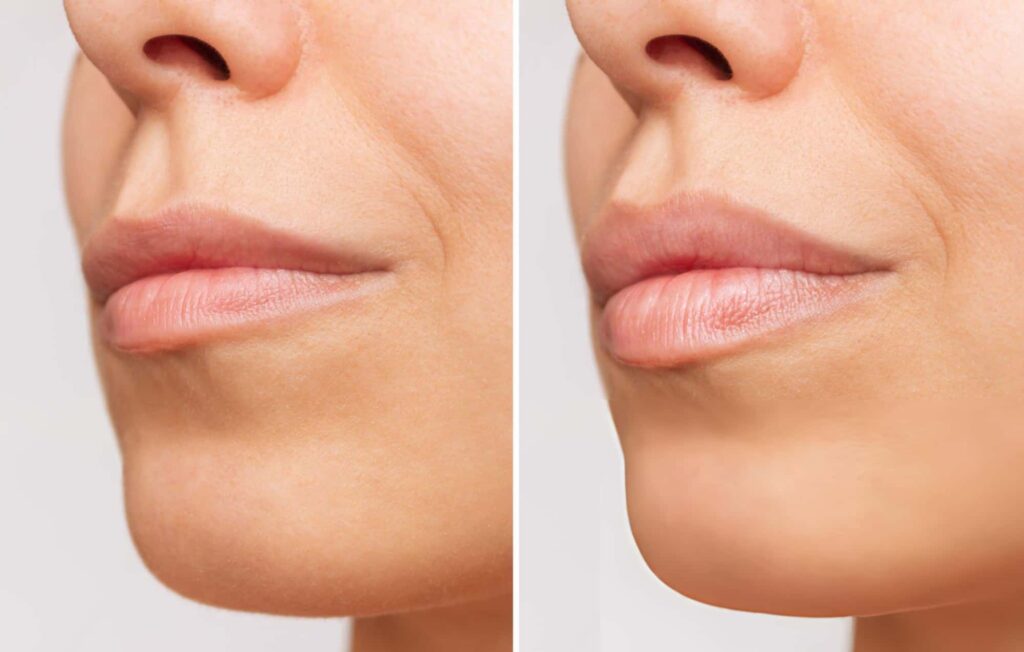 Lip Fillers - Accent on Skin