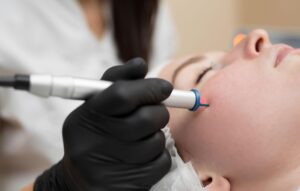 CryoPen Treatment