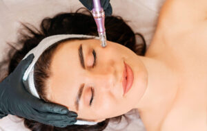 Why Dermal Needling Is for You, Not Just for Celebrities