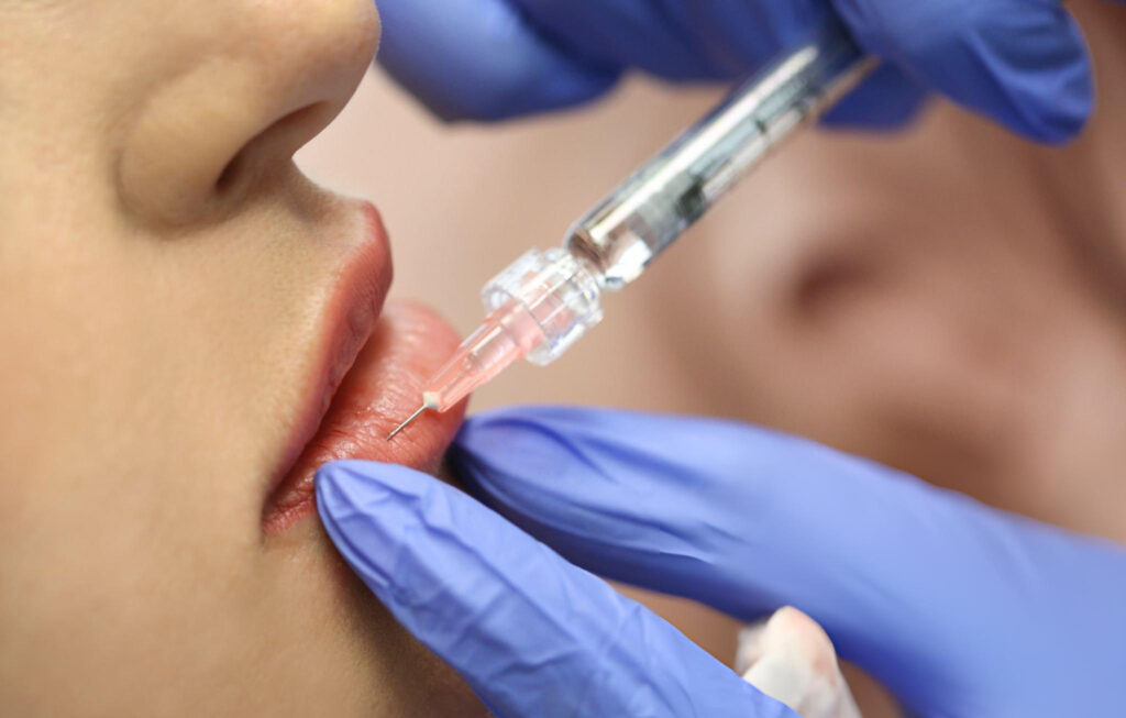 Dermal Filler