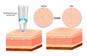 Skin Rejuvenation Treatment Wellington