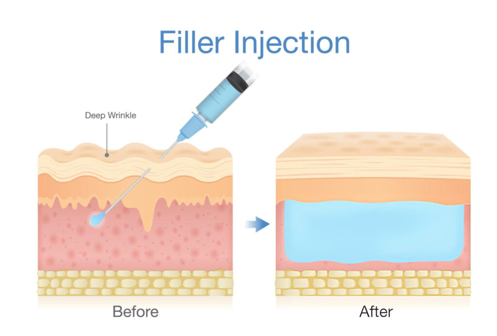 Dermal Filler