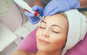 Dermal Needling with Dermapen, Accent on Skin, Wellington, NZ